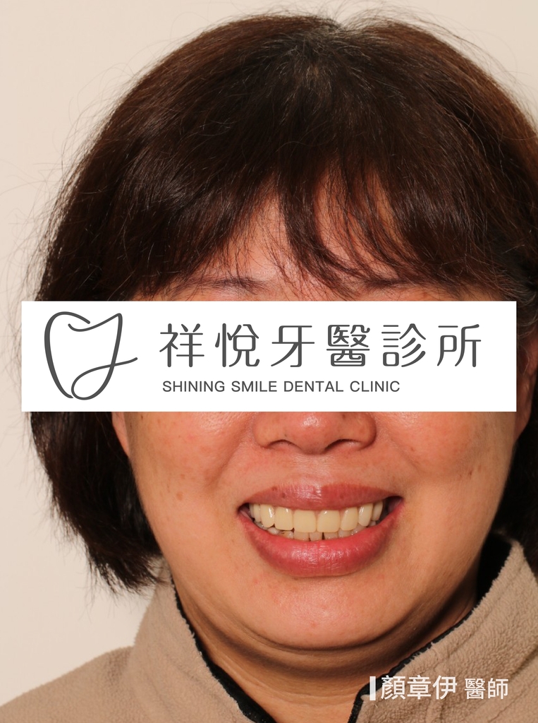 全口重建治療後