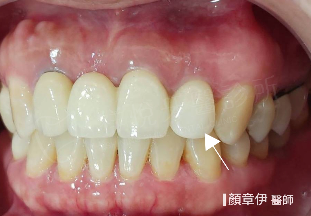 即拔即種治療後