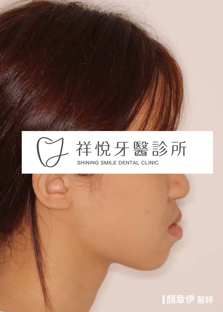 隱適美矯正治療前