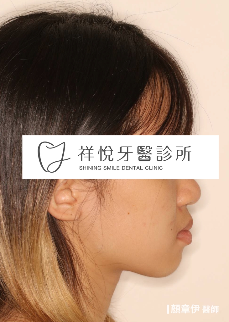 隱適美矯正治療後