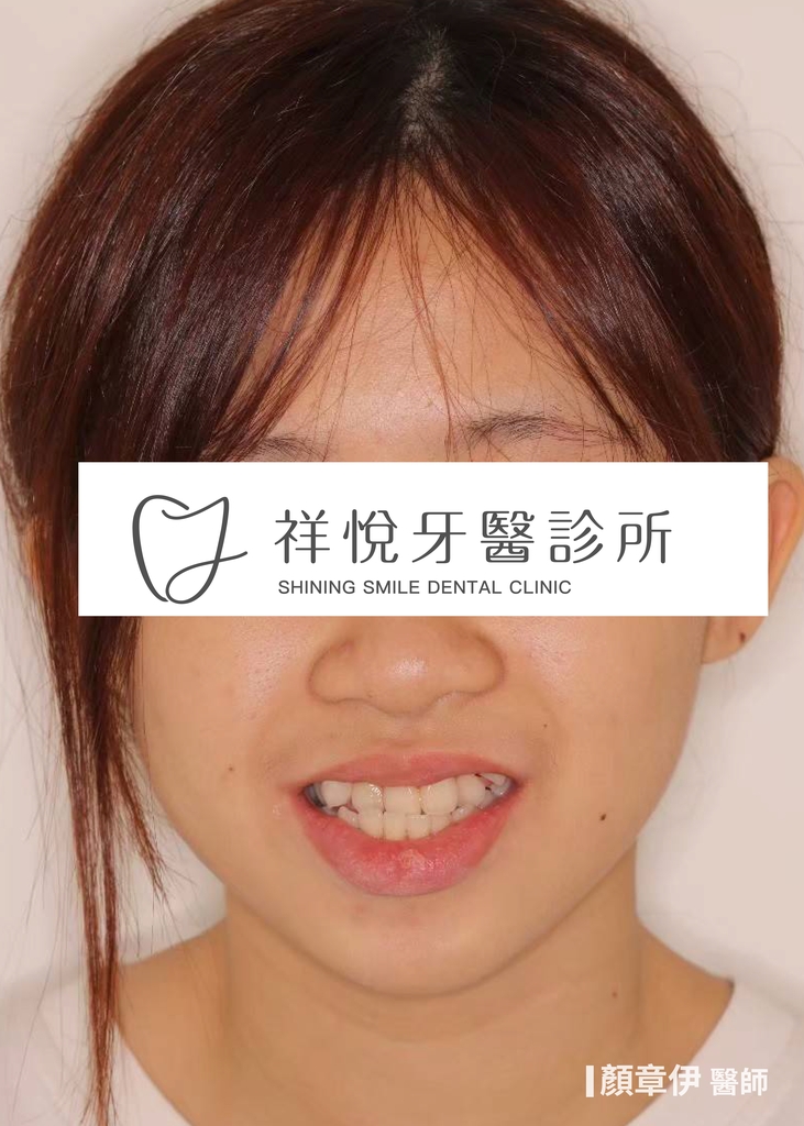 隱適美矯正治療前