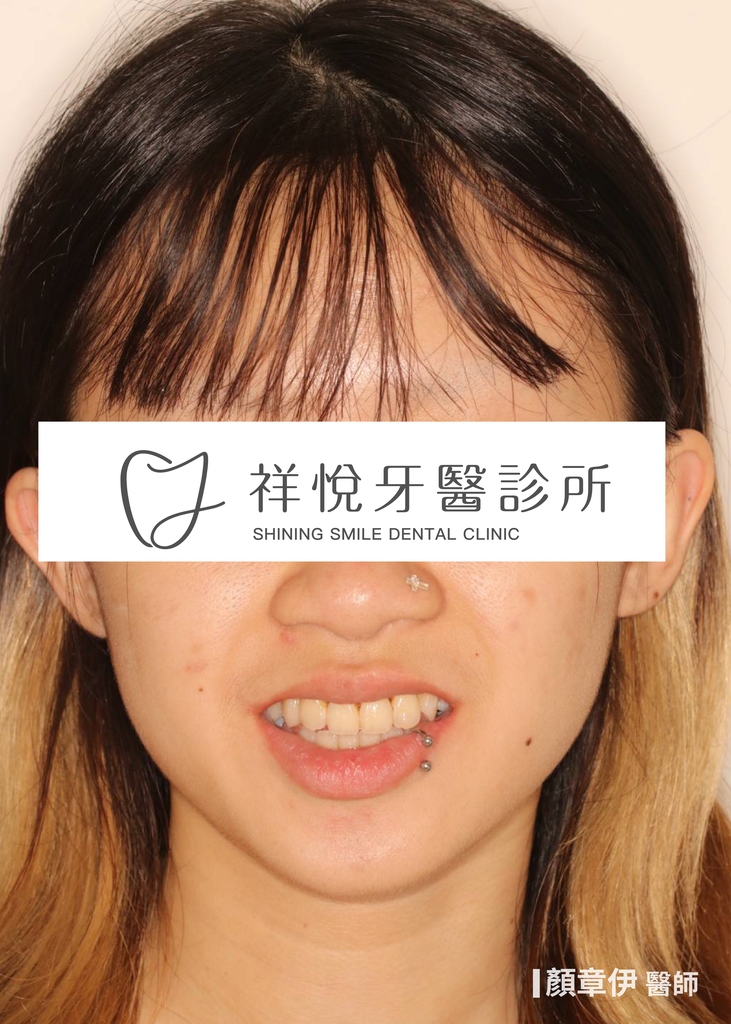 隱適美矯正治療後