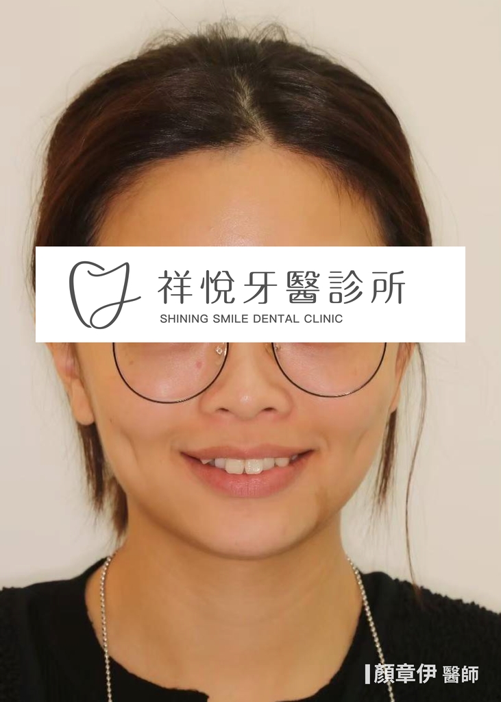 隱適美矯正治療前