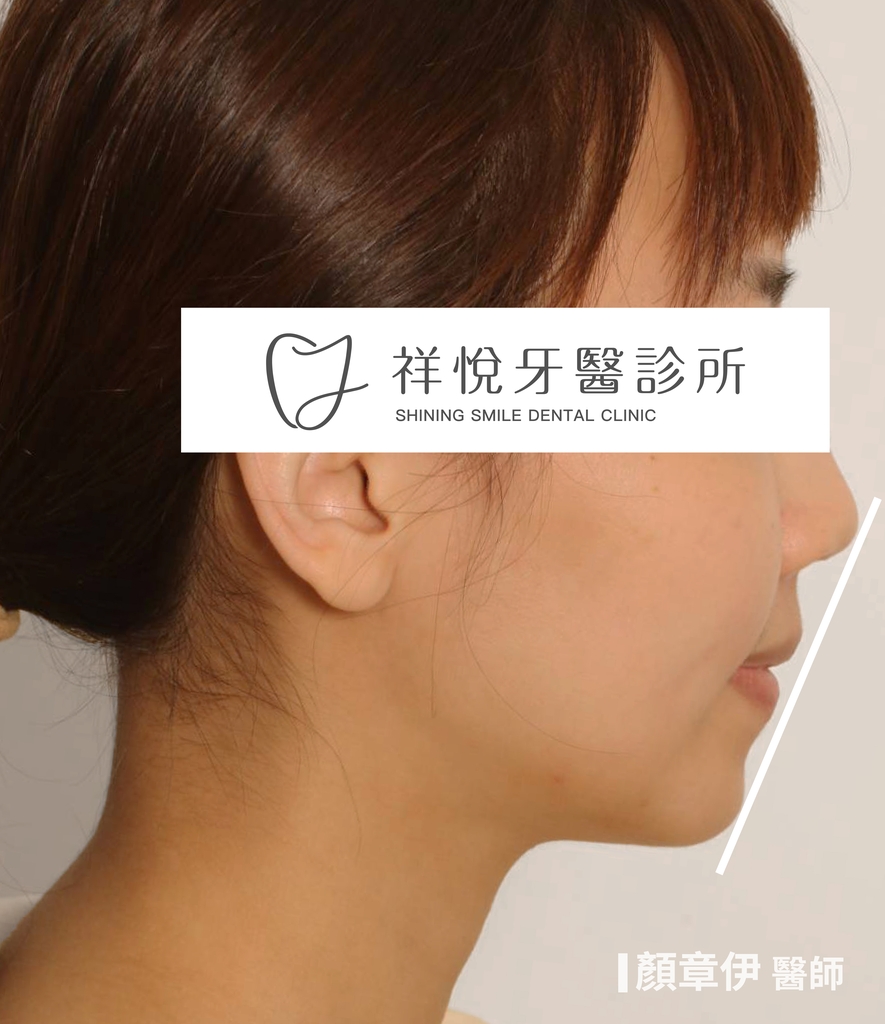 隱適美矯正治療後