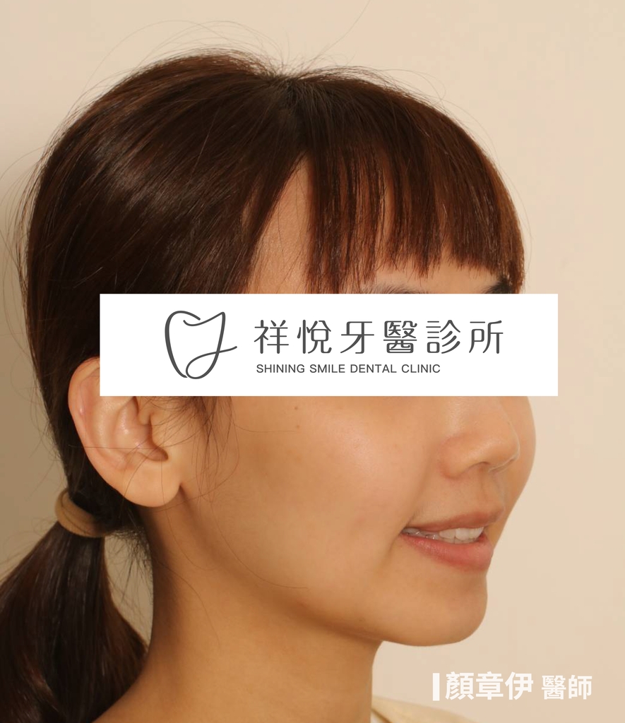 隱適美矯正治療後