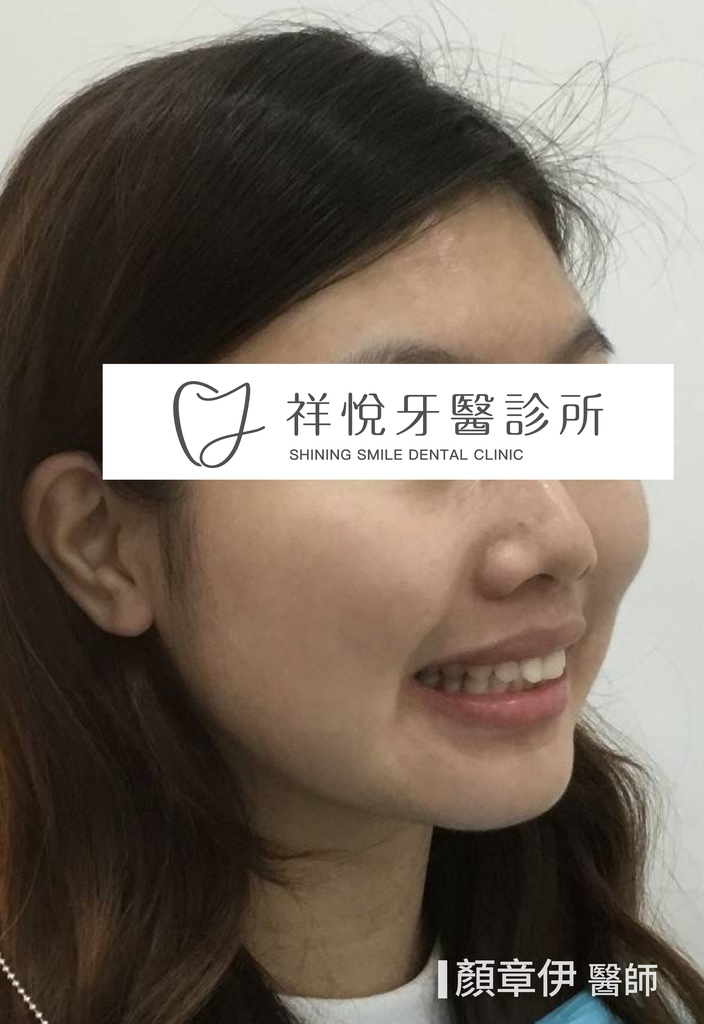 傳統矯正治療後