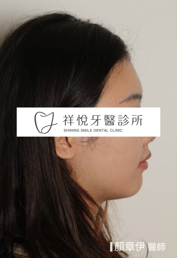 傳統矯正治療前