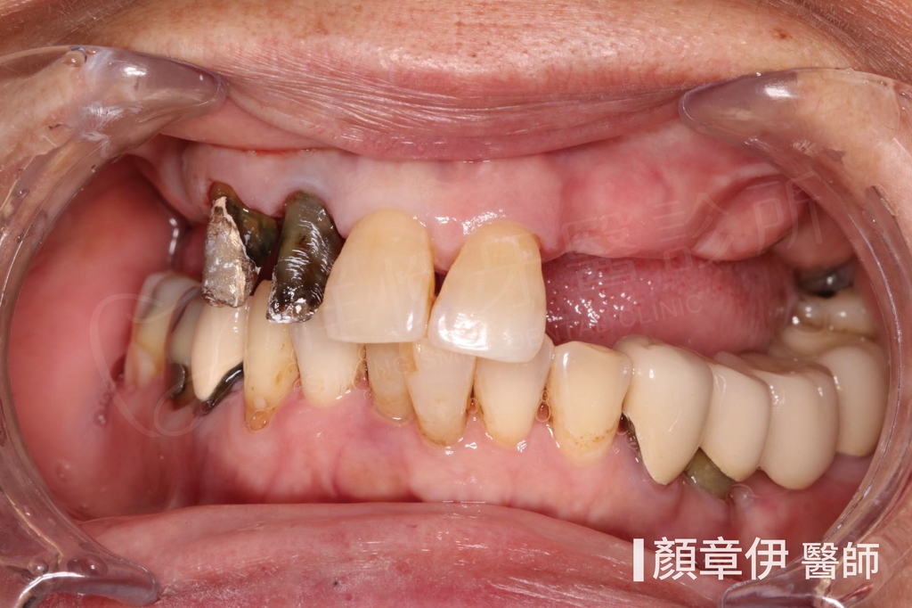 顏章伊醫師 後牙多顆缺牙植牙案例 治療前（湖口祥悅牙醫）