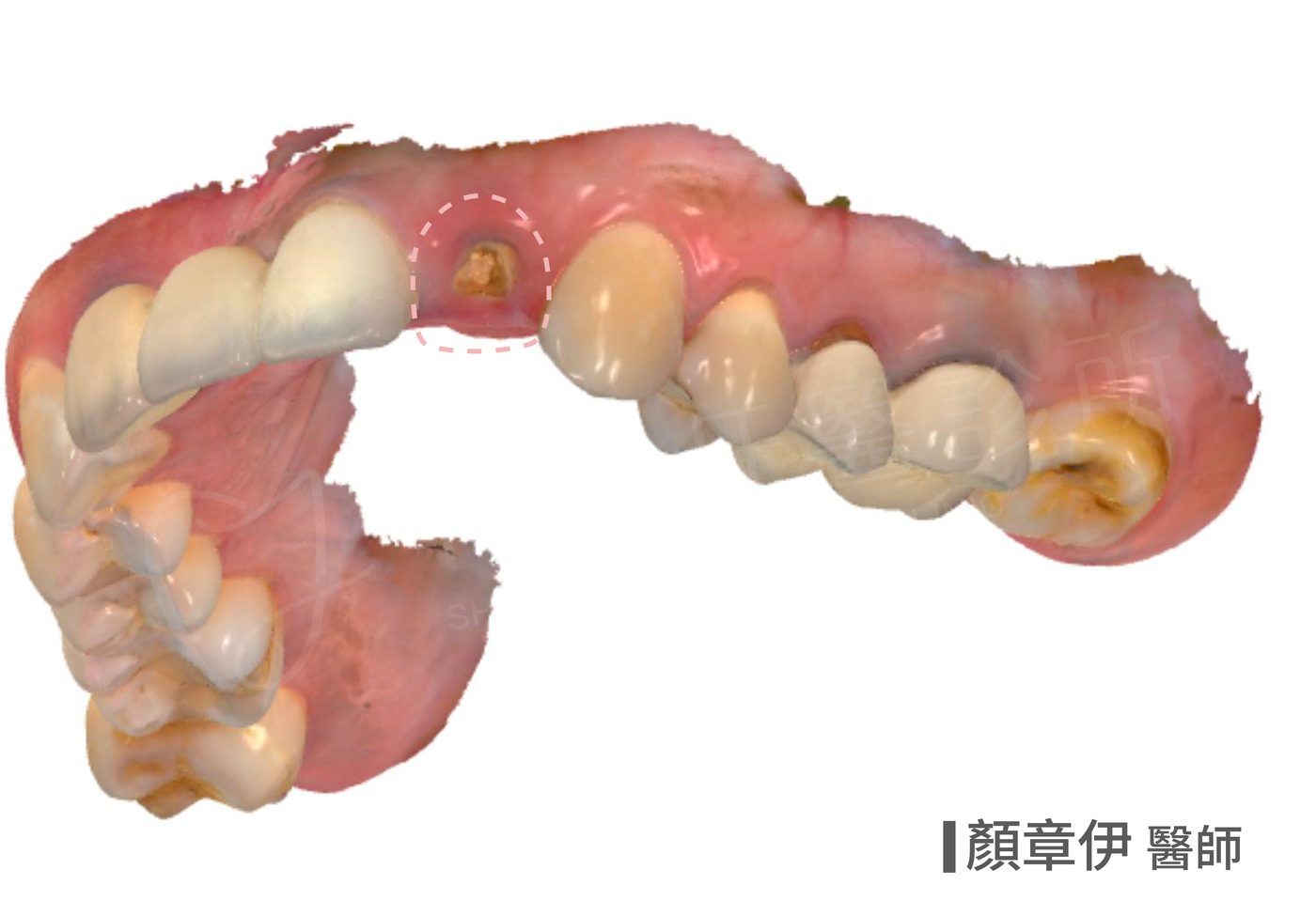 左上門牙斷裂治療前 即拔即種案例 顏章伊醫師 祥悅牙醫