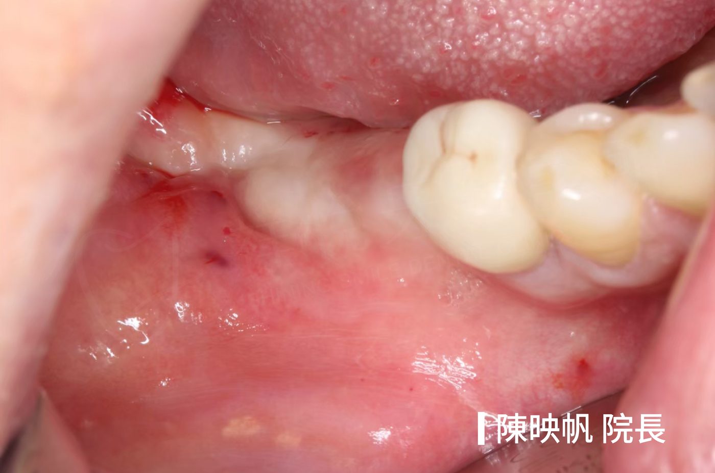 牙周病後牙晃動治療前 口內照 後牙植牙案例 陳映帆院長 祥悅牙醫