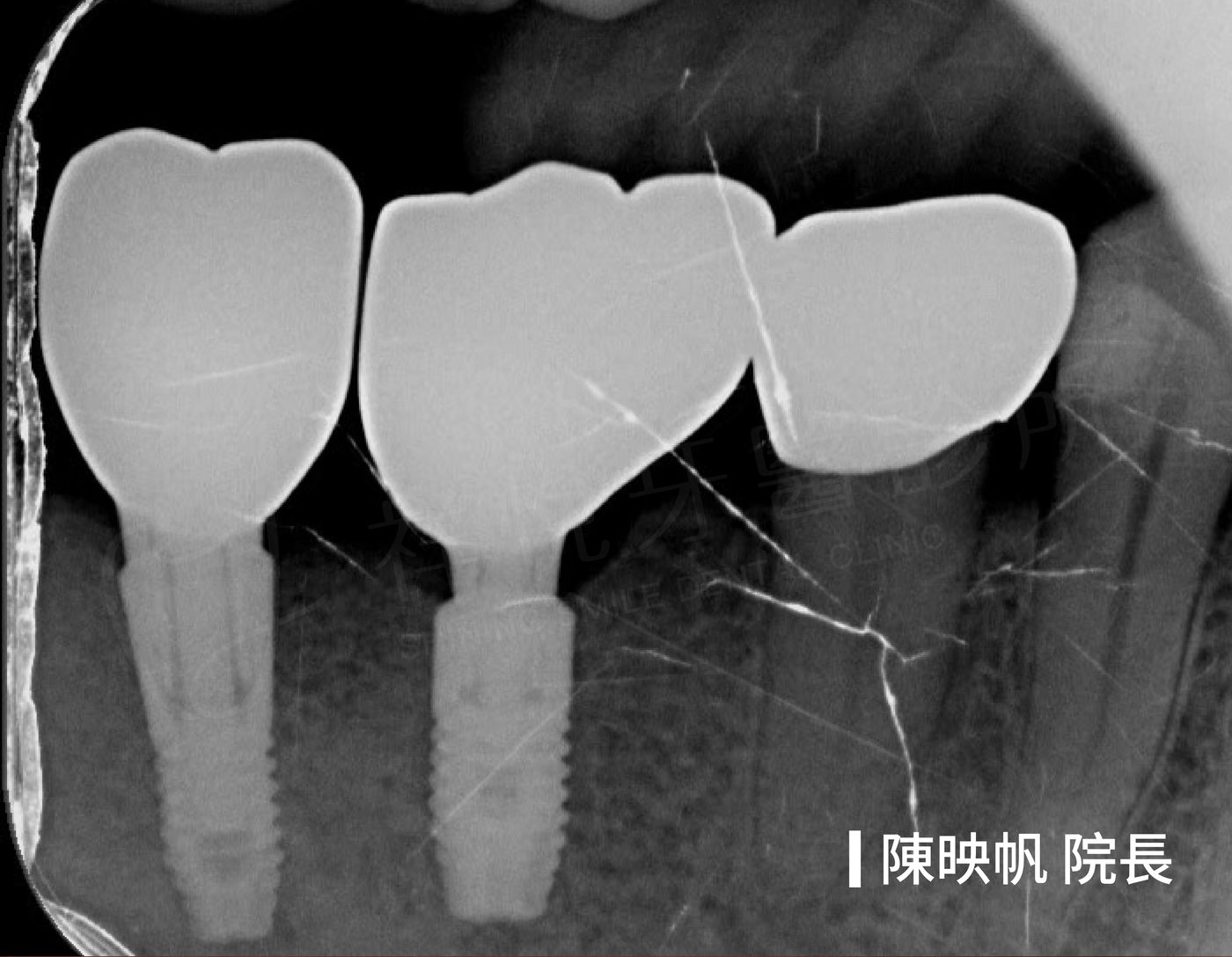 補骨後植牙治療後 X光 植體與假牙 陳映帆院長 祥悅牙醫