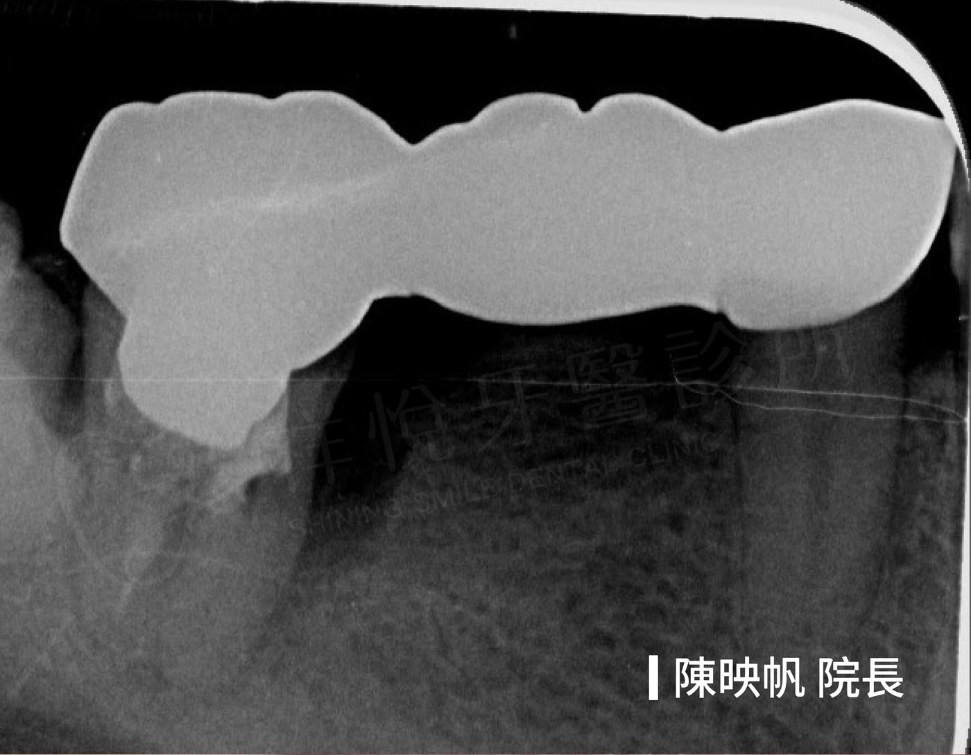 後牙植牙治療前 X光 牙周病齒槽骨不足 陳映帆院長 祥悅牙醫
