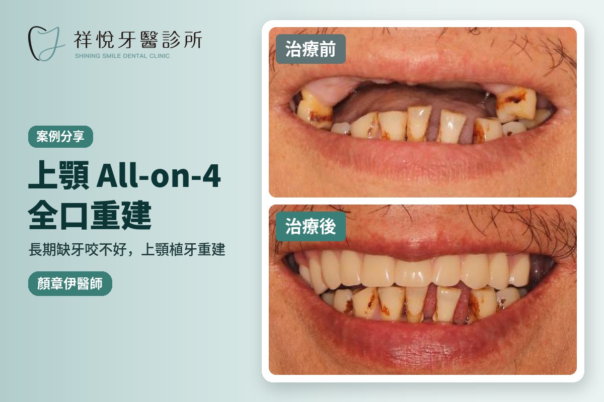 長期缺牙上顎All-on-4全口重建案例 治療前後對比 顏章伊醫師｜湖口祥悅牙醫