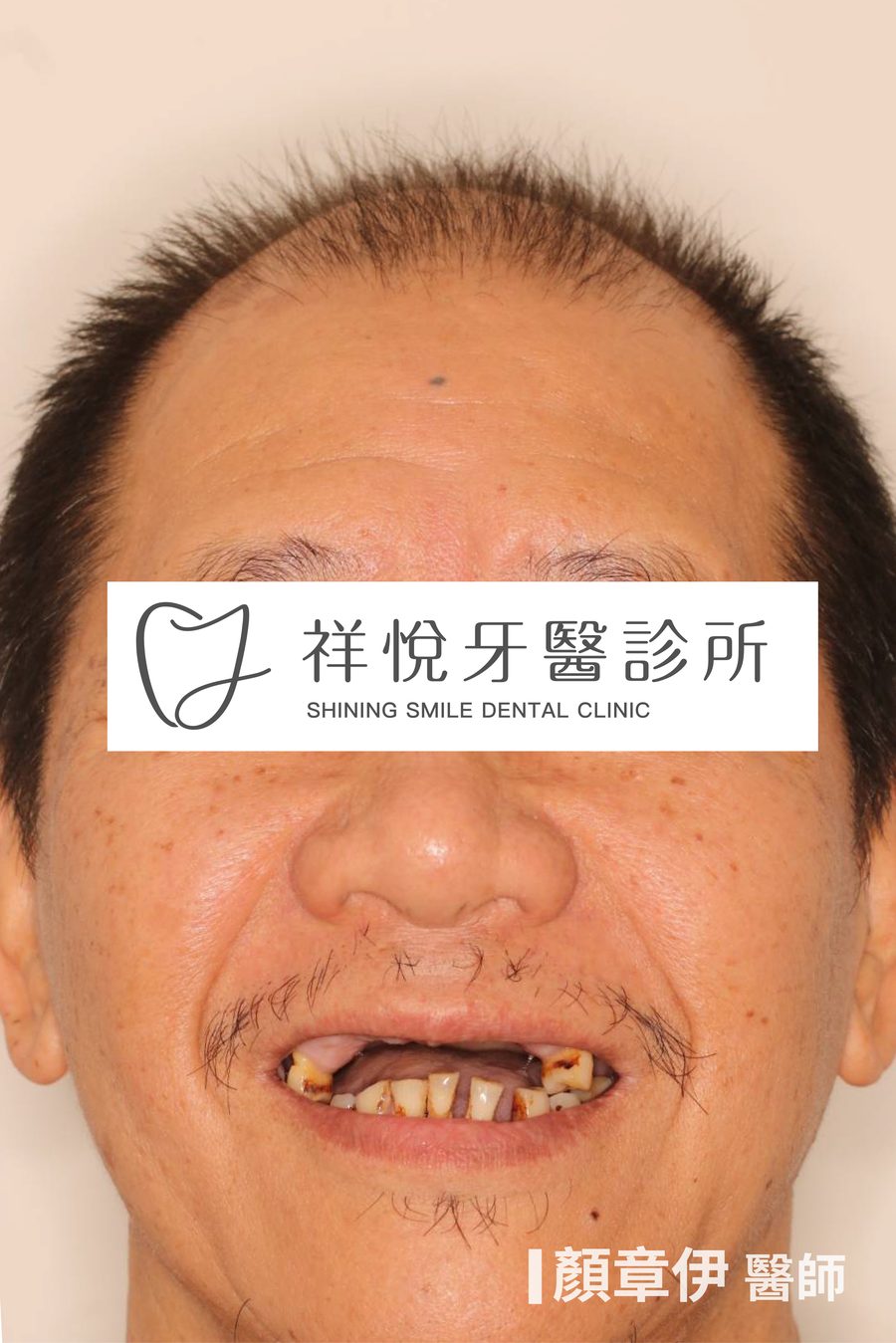 上顎長期缺牙治療前 笑容 All-on-4全口重建案例 顏章伊醫師 湖口祥悅牙醫